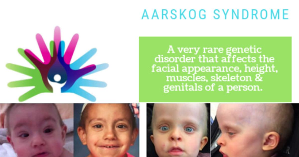 Aarskog Syndrome Managemen